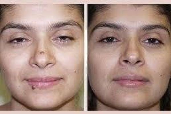 Laser-Based Mole Removal in Dubai Explained Simply | Safe Skin Solutions Guide