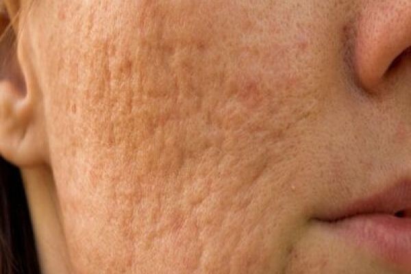 Stretch Mark and Scar Removal in Dubai Solutions: Advanced Skin Renewal Options