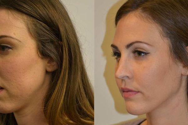 The Science of Facial Lower Third Proportions in Jawline Surgery in Islamabad