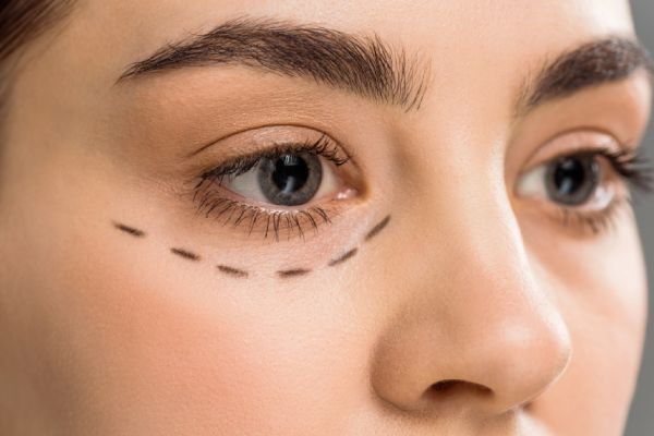 Is Blepharoplasty a Permanent Solution for Droopy Eyelids?