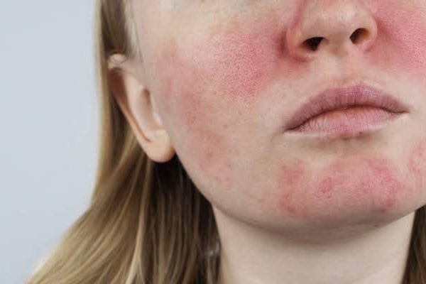 Rosacea Treatment In Islamabad: Expert Insights for Better Skin Health