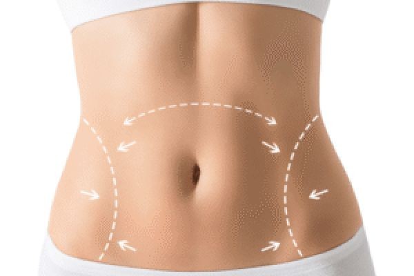 HD Liposuction in Dubai: Expert Guide to Body Sculpting