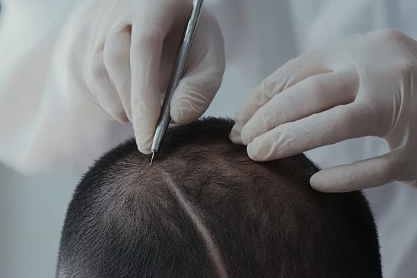 Expected Hair Growth and Density After DHI Direct Hair Implant in Dubai