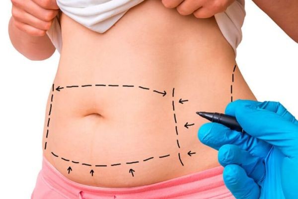 Understanding Fat Removal Options in Dubai Liposuction Guide?