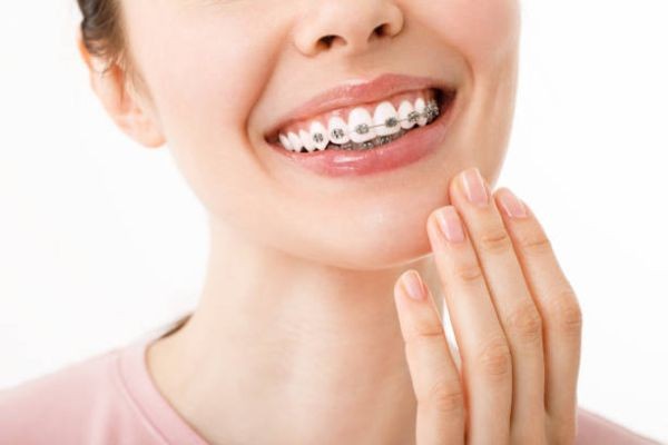 What to Expect When Getting Teeth Braces in Islamabad Pakistan