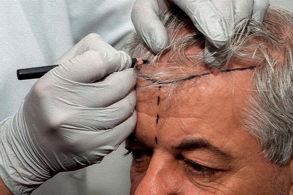 Hair Transplant in Islamabad: Common Mistakes to Avoid Before Surgery