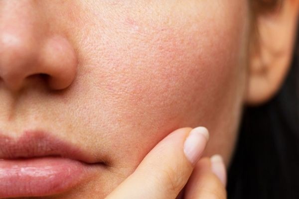 Effective Home Remedies Combined with Dry Skin Treatment in Islamabad
