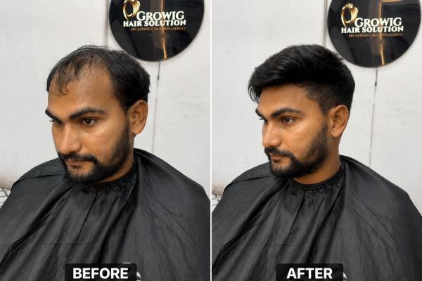 Custom Hair Patch Design in Dwarka: Get a Personalized Hair Solution with Growighairsolution