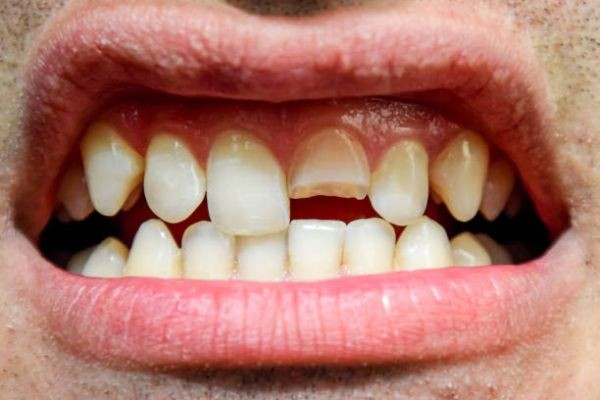 Modern Dental Solutions for Stronger and Healthier Teeth Tooth Fracture Treatment in Pakistan: