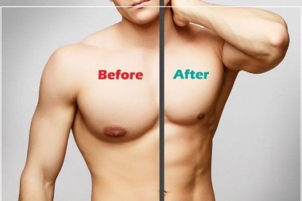 Gynaecomastia Surgery in Dubai: Surgical Excellence