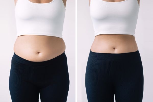 Post Weight Loss in Islamabad and Rebuilding Self-Confidence