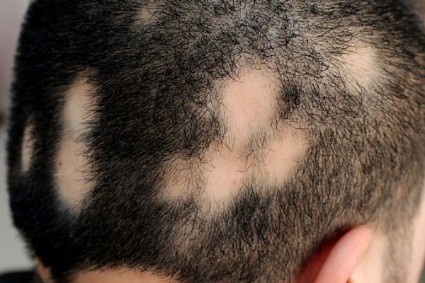 Natural vs Medical Options for Alopecia Areata Treatment In Islamabad