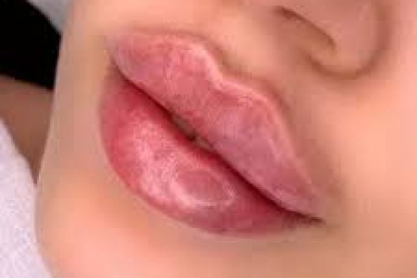 Lip Aesthetics Redefined with Russian Lip Filler in Dubai – Natural Lift & Shape