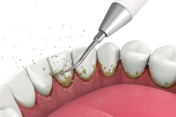 Why Regular Teeth Scaling and Polishing Are Essential for a Cleaner and Healthier Smile