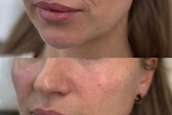 Sculptra Fillers in Dubai: A Sophisticated Regenerative Choice