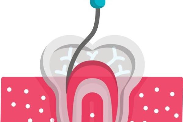 The Best Way to Treat Deep Tooth Infections Root Canal Treatment in Islamabad Pakistan: