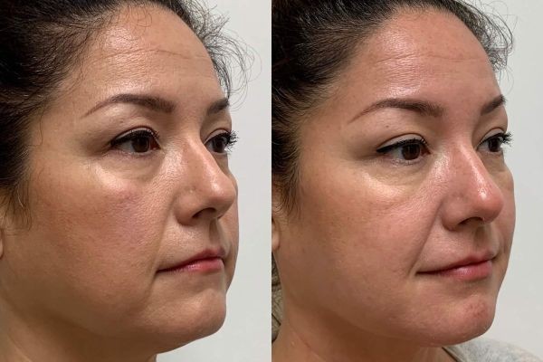 Silhouette Soft Thread Lift in Dubai: Subtle Facelift