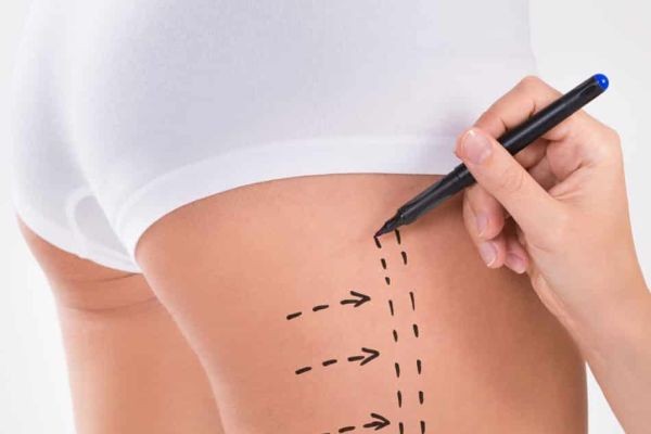 Common Side Effects of Thigh Liposuction in Islamabad