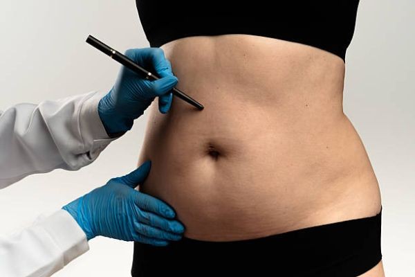 Liposuction vs Tummy Tuck: Which Is Right for You?