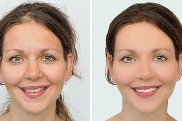 Smile Makeover in Indiranagar for a Confident and Radiant Smile - American Dental Practices