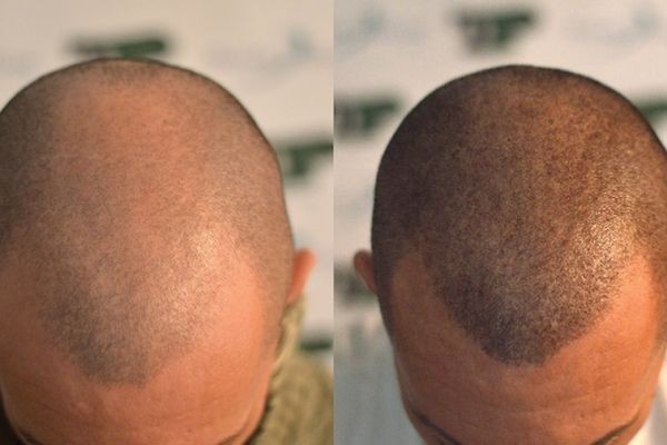 Hair Transplant in Dubai: Modern Science for Hair Loss