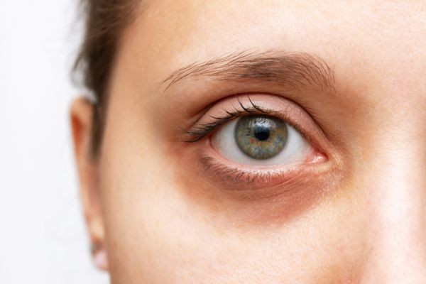How results improve Dark circles treatment in Dubai