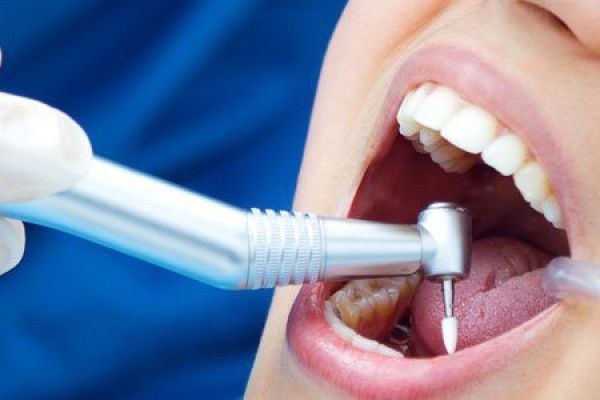 Why Dental Filling in Islamabad is Essential for Long-Term Oral Health