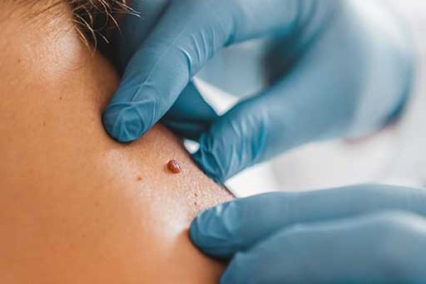 How Advanced Technology Supports Mole Removal in Dubai | Clear Skin Solutions