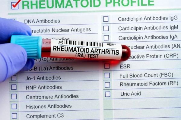 Understanding Positive RA Factor and ANA Results: What Do They Mean?