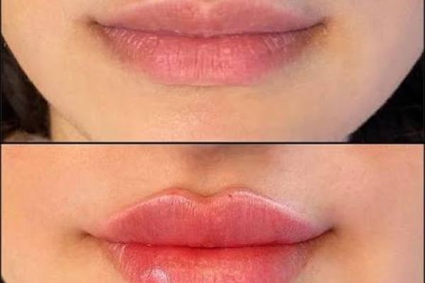 A Beginner's Guide to Russian Lip Fillers in Dubai | Natural Lip Enhancement