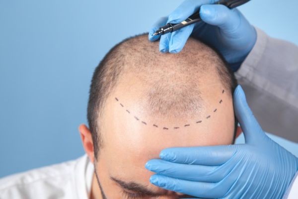 Clinics Specializing in Hair Transplant in Ras Al Khaimah UAE