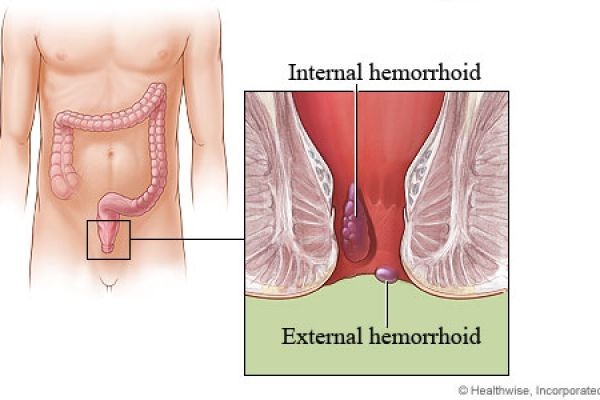 Benefits of Haemorrhoids Treatment in Dubai for Lasting Relief
