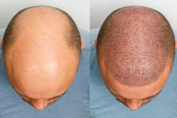 Hair Transplant in Dubai: Advanced Technology for Natural Hair Growth