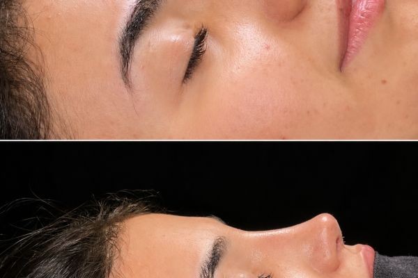 How Rhinoplasty in Islamabad Can Influence First Impressions and Confidence