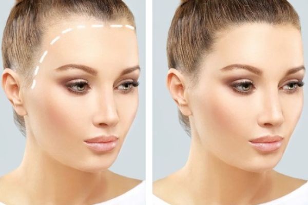 Hair Transplant in Dubai Recovery Process and Healing Guide