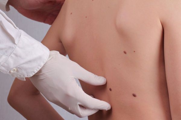 How Skin Tag Removal in Islamabad Supports Better Skin Confidence