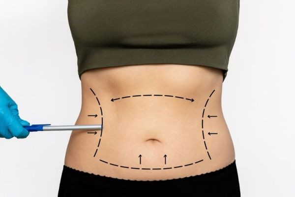 Tummy Tuck in Dubai: Your Path to a Sculpted Core
