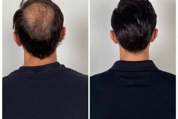 Crown Hair Transplant in Dubai: Advanced Techniques