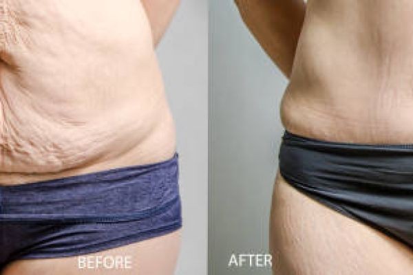 Tummy Tuck in Dubai for Stubborn Belly Skin Removal