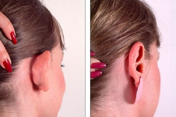 Ear Reshaping in Dubai: Transforming Ears with Precision