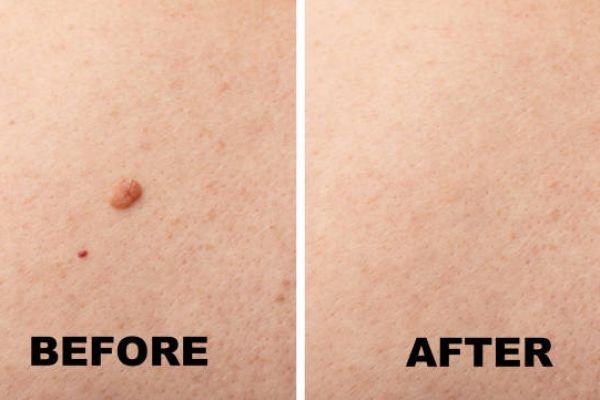Skin Lesion Removal in Dubai with Advanced Technology