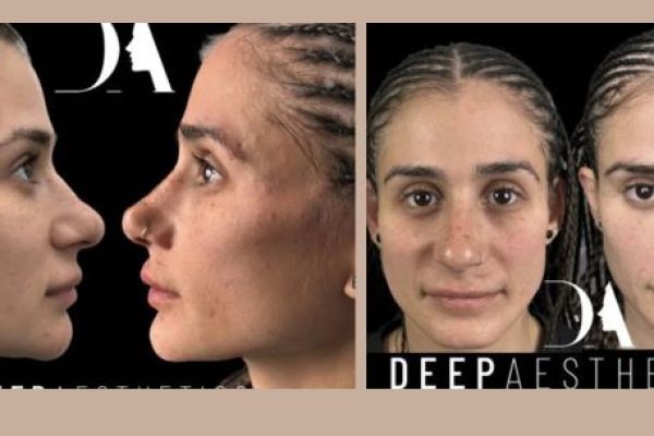 3 Point Face Lift in London: Achieve Natural Facial Rejuvenation