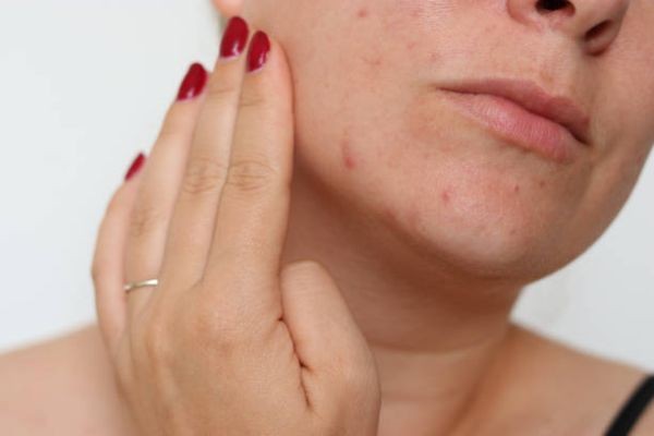 What to Ask Before Starting Laser Acne Scar Treatments