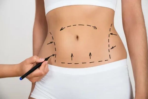 Liposuction in Dubai: Defining Your New Contours