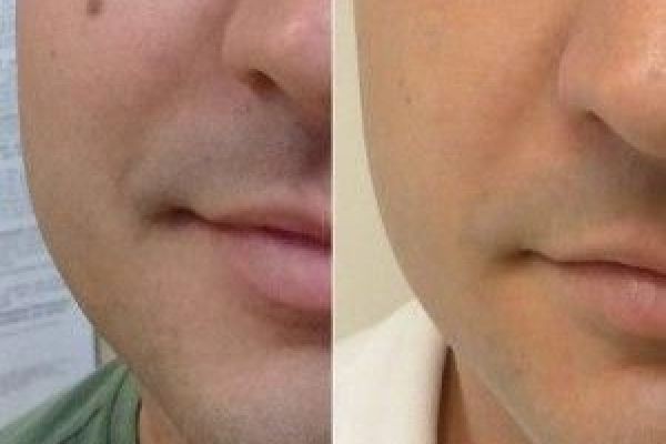 Mole removal in Dubai: Tailored Skin Care Solutions