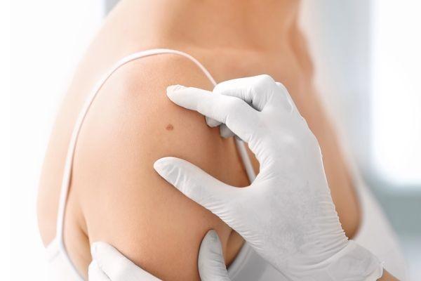 Birthmark Removal in Islamabad: Modern Techniques for Smoother Skin