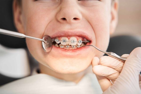 Braces Cost in Pakistan: What Influences the Final Treatment Cost?
