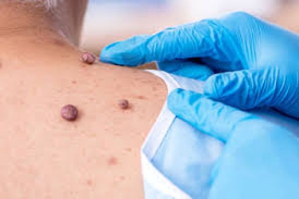 Mole Removal in Dubai | Advanced Treatments for Clear Skin