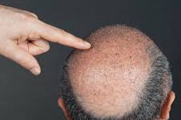 Hair Transplant in Dubai: Benefits, Procedure & Recovery Guide