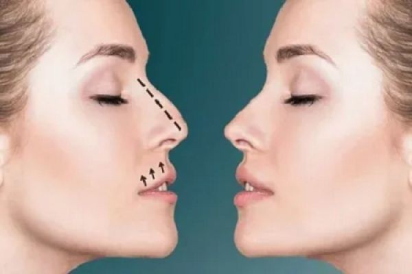 Rhinoplasty in Dubai: Navigating Your Surgical Journey